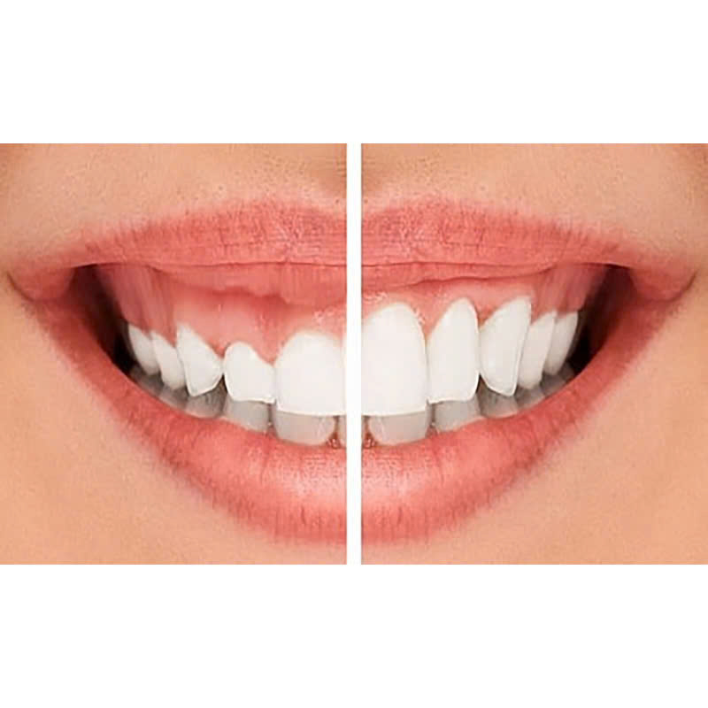 cat-loi-co-anh-huong-toi-suc-khoe-rang-mieng-khong-nhung-doi-tuong-nao-phu-hop-voi-phuong-phap-nay