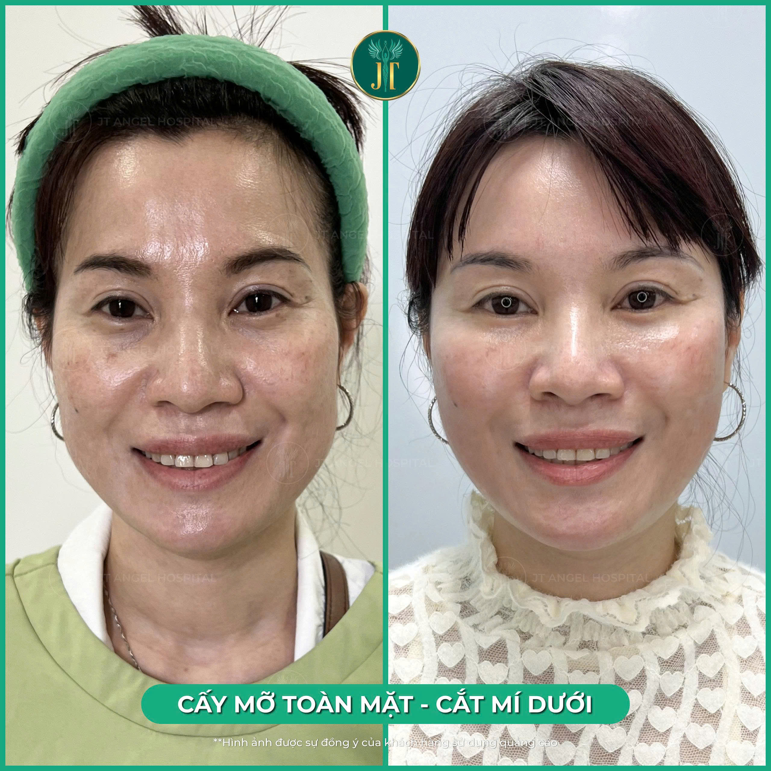 cat-mi-duoi-va-lay-mo-mi-duoi-la-gi-phan-tich-uu-nhuoc-diem-ro-rang-va-nhung-ai-phu-hop-lam-phuong-phap-nay