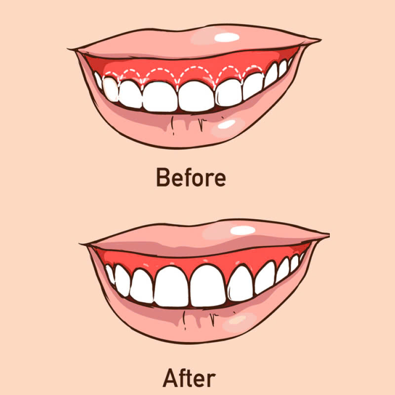 cat-ngan-ho-loi-noi-loi-tam-biet-voi-nu-cuoi-thieu-tham-my-tu-tin-voi-nu-cuoi-rang-ro