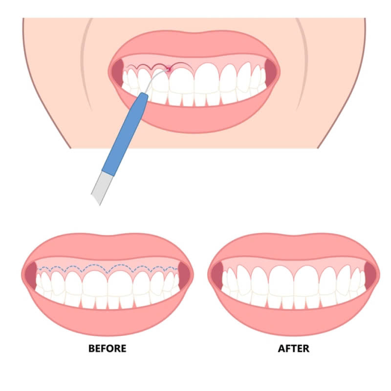 cat-ngan-ho-loi-noi-loi-tam-biet-voi-nu-cuoi-thieu-tham-my-tu-tin-voi-nu-cuoi-rang-ro