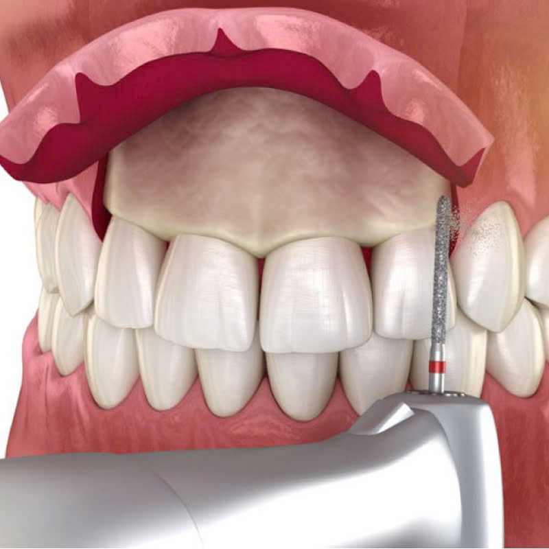 phuong-phap-cat-nuou-chinh-xuong-co-lam-rang-yeu-di-khong