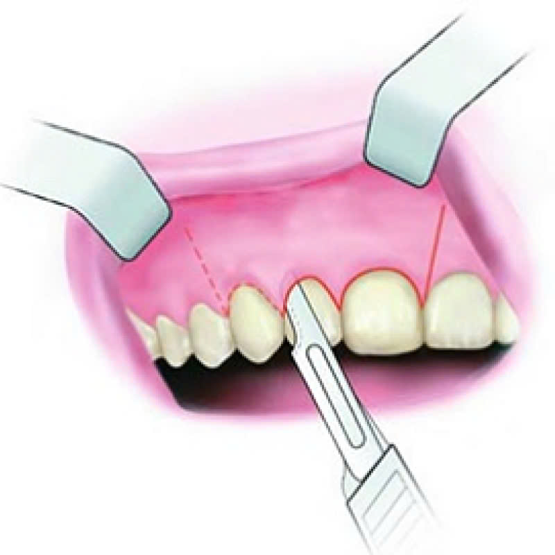 phuong-phap-cat-nuou-chinh-xuong-co-lam-rang-yeu-di-khong