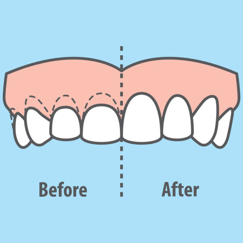 cat-nuou-lam-dai-than-rang-la-gi-dich-vu-nay-phu-hop-voi-nhung-doi-tuong-nao