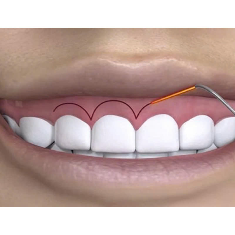 cat-nuou-lam-dai-than-rang-la-gi-dich-vu-nay-phu-hop-voi-nhung-doi-tuong-nao