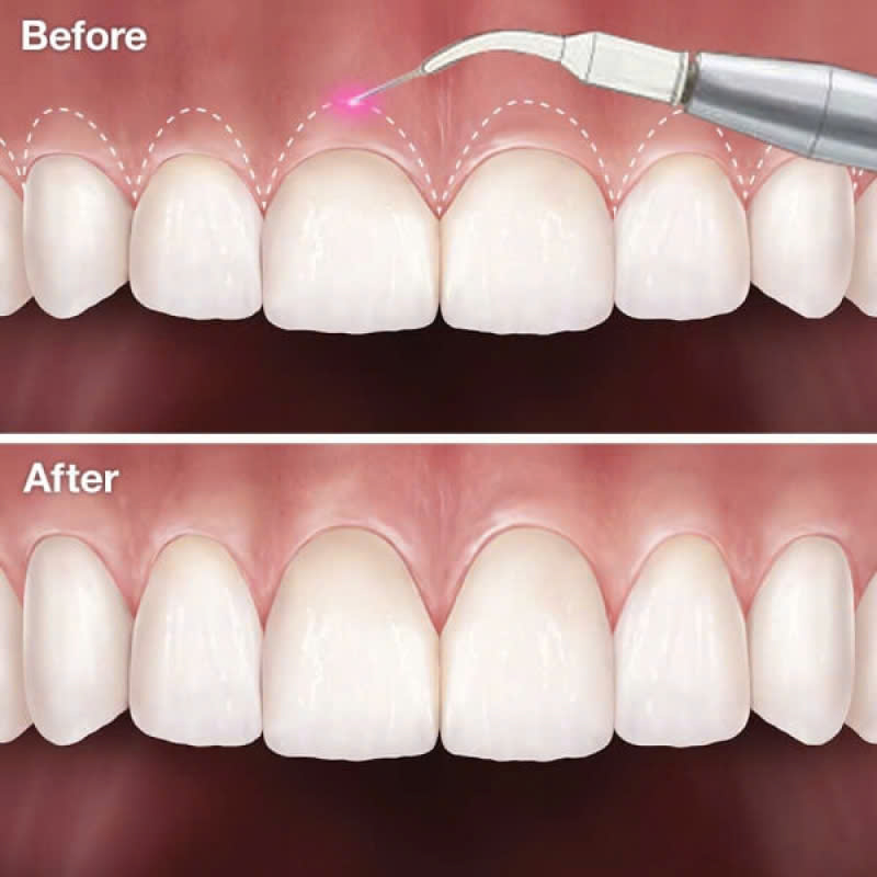 cat-nuou-lam-dai-than-rang-la-gi-dich-vu-nay-phu-hop-voi-nhung-doi-tuong-nao