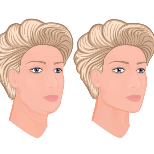 cay-mo-mat-bao-lau-thi-dep-tu-nhien-cung-tim-hieu-lo-trinh-hoi-phuc-tung-giai-doan-cua-phuong-phap-lam-dep-nay