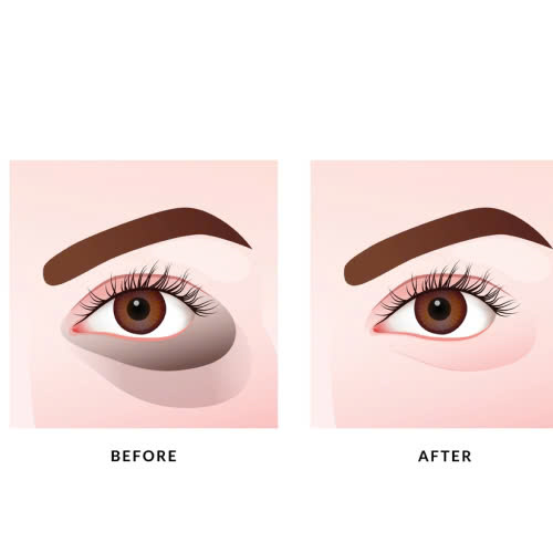 cay-mo-mat-bao-lau-thi-lanh-giai-dap-chi-tiet-qua-trinh-hoi-phuc-sau-cay-mo-mat