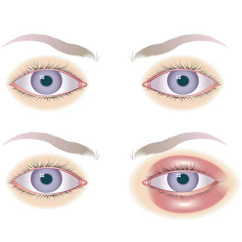 cay-mo-mat-bi-hong-phai-lam-sao-huong-dan-khac-phuc-an-toan-lay-lai-doi-mat-dep-tu-nhien