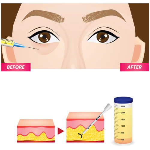 cay-mo-mat-bi-hong-phai-lam-sao-huong-dan-khac-phuc-an-toan-lay-lai-doi-mat-dep-tu-nhien