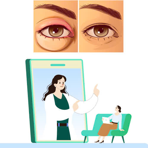 cay-mo-mat-bi-hong-phai-lam-sao-huong-dan-khac-phuc-an-toan-lay-lai-doi-mat-dep-tu-nhien