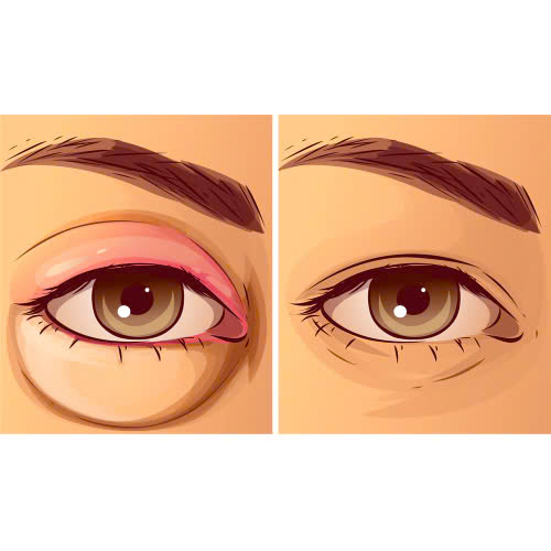 cay-mo-mat-bi-von-cuc-co-nguy-hiem-khong-cung-tim-hieu-nguyen-nhan-dau-hieu-va-cach-khac-phuc-phong-ngua-hieu-qua