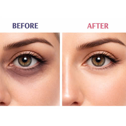 cay-mo-mat-co-nguy-hiem-khong-vi-sao-nen-chon-cay-mo-tu-than-thay-vi-chon-cac-phuong-phap-khac