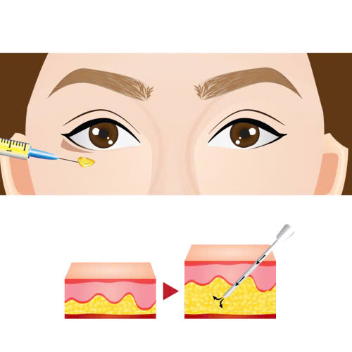 cay-mo-mat-giu-duoc-bao-lau-giai-dap-cac-yeu-to-anh-huong-den-thoi-gian-duy-tri-sau-khi-cay-mo-mat