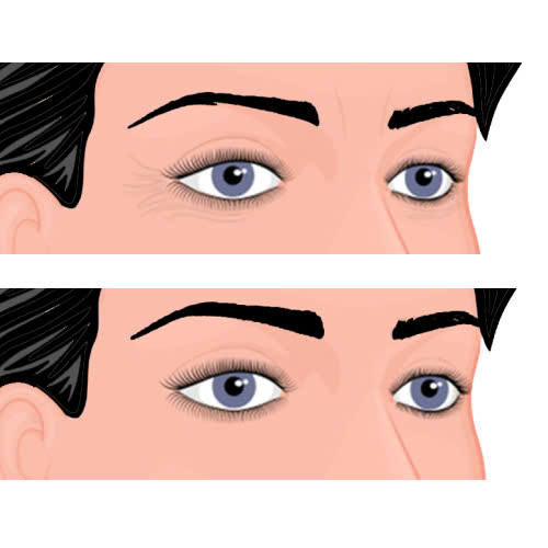 cay-mo-mat-giu-duoc-bao-lau-giai-dap-cac-yeu-to-anh-huong-den-thoi-gian-duy-tri-sau-khi-cay-mo-mat