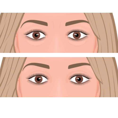 cay-mo-mat-hay-tiem-filler-tot-hon-so-sanh-chi-tiet-giup-ban-lua-chon-dung-giai-phap-phu-hop-voi-ban-than