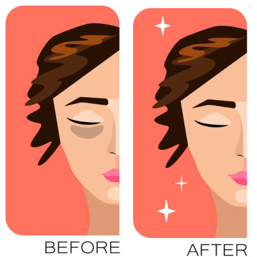 phuong-phap-cay-mo-mat-tu-than-la-gi-cung-tim-hieu-giai-phap-giup-tre-hoa-doi-mat-tu-nhien-an-toan-va-hieu-qua