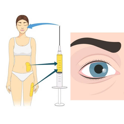 phuong-phap-cay-mo-mat-tu-than-la-gi-cung-tim-hieu-giai-phap-giup-tre-hoa-doi-mat-tu-nhien-an-toan-va-hieu-qua