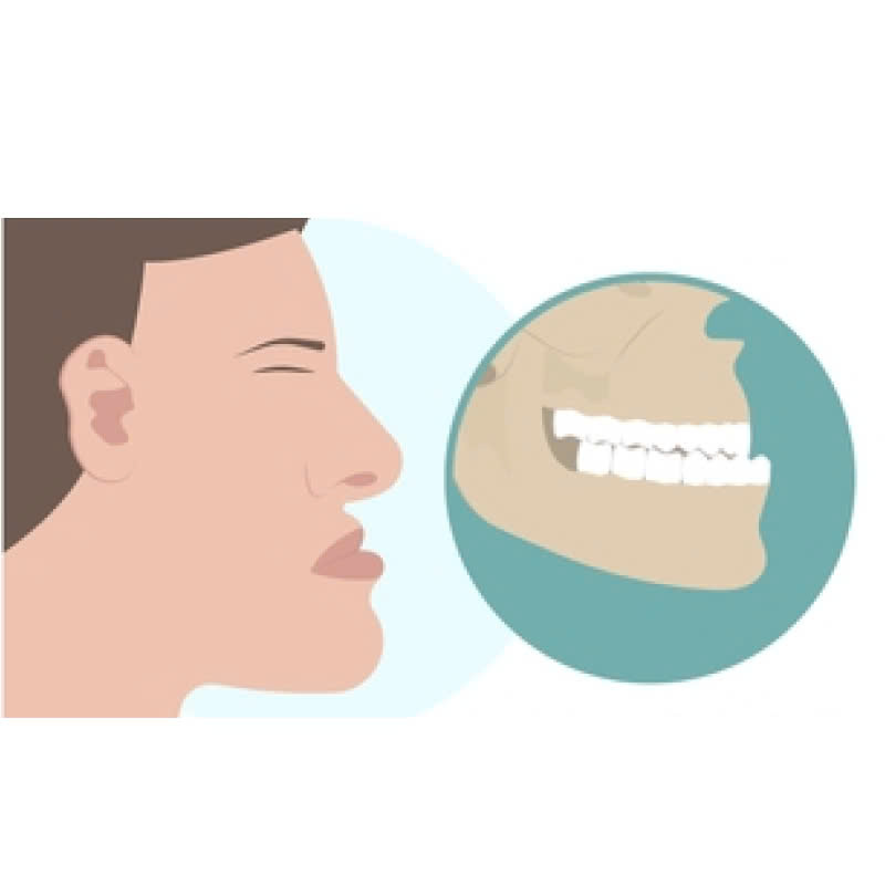 chinh-ham-duoi-la-gi-phuong-phap-cai-thien-nhanh-chong-tinh-trang-ham-lech-tai-tao-hoan-hao-lai-nu-cuoi-tu-tin