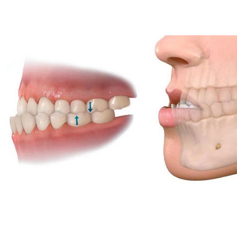 chinh-ham-duoi-la-gi-phuong-phap-cai-thien-nhanh-chong-tinh-trang-ham-lech-tai-tao-hoan-hao-lai-nu-cuoi-tu-tin