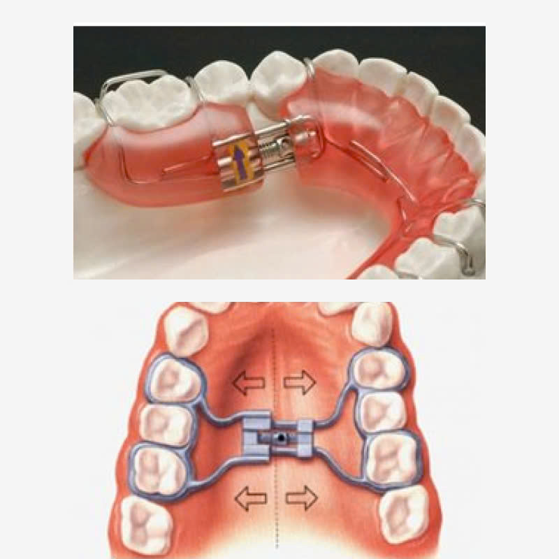 chinh-ham-duoi-la-gi-phuong-phap-cai-thien-nhanh-chong-tinh-trang-ham-lech-tai-tao-hoan-hao-lai-nu-cuoi-tu-tin