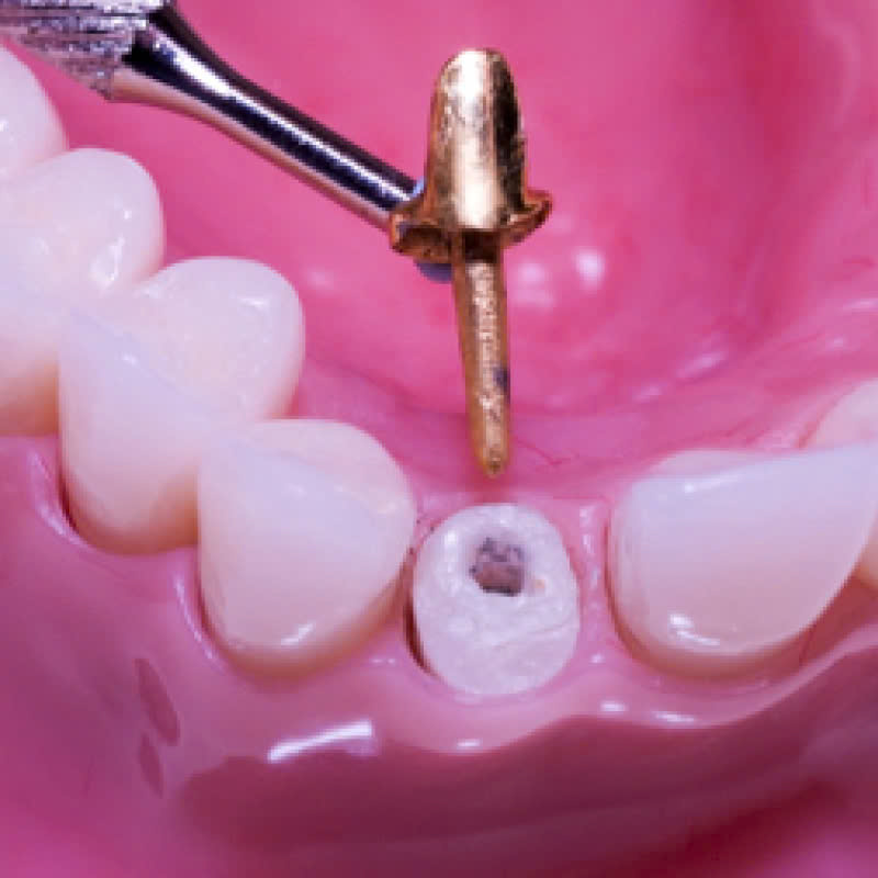 cui-rang-theo-kim-loai-quy-la-gi-phuong-phap-nay-phu-hop-voi-nhung-doi-tuong-nao