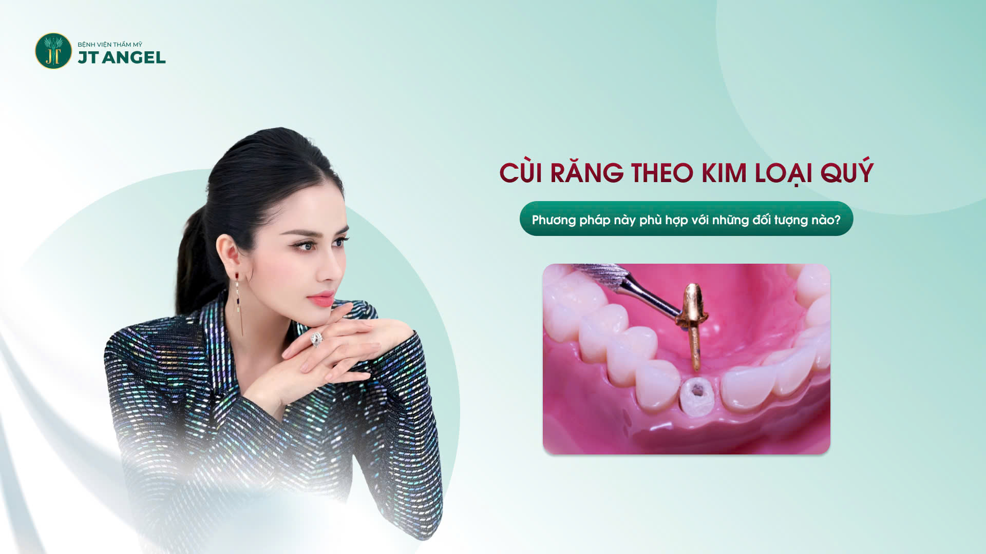 cui-rang-theo-kim-loai-quy-la-gi-phuong-phap-nay-phu-hop-voi-nhung-doi-tuong-nao