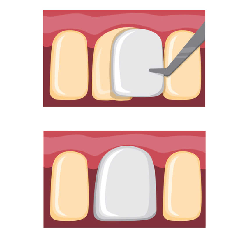 dan-su-veneer-loai-bo-tinh-trang-ham-rang-o-vang-sut-me-giup-ban-so-huu-ham-rang-trang-sang-deu-dep