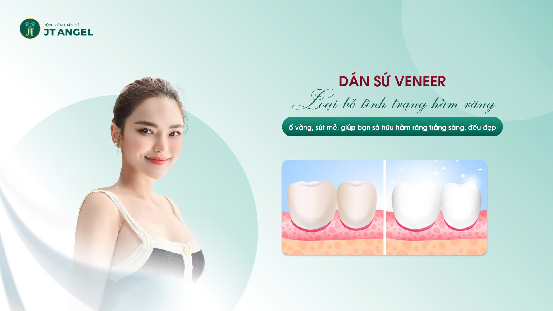 dan-su-veneer-loai-bo-tinh-trang-ham-rang-o-vang-sut-me-giup-ban-so-huu-ham-rang-trang-sang-deu-dep