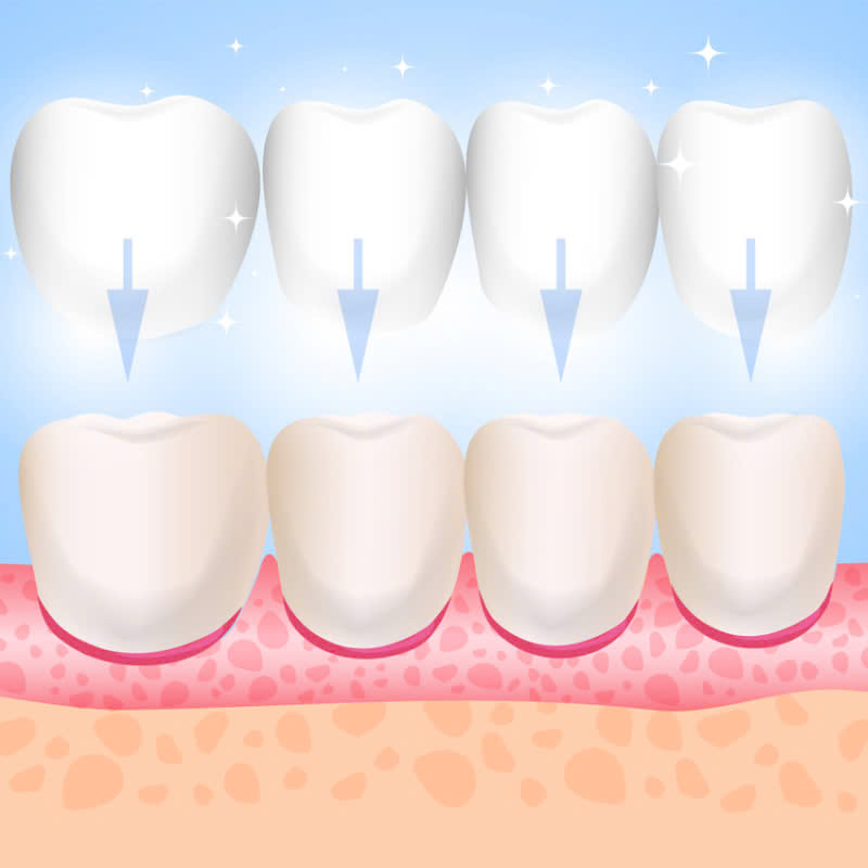 dan-su-veneer-loai-bo-tinh-trang-ham-rang-o-vang-sut-me-giup-ban-so-huu-ham-rang-trang-sang-deu-dep