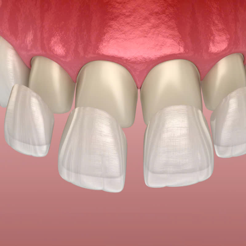 dan-su-veneer-loai-bo-tinh-trang-ham-rang-o-vang-sut-me-giup-ban-so-huu-ham-rang-trang-sang-deu-dep