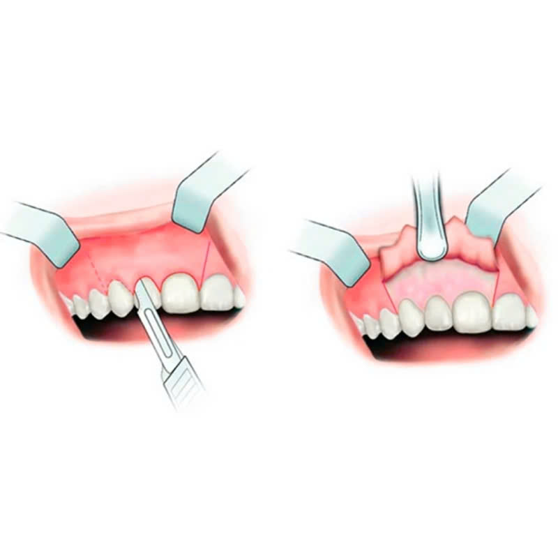 dieu-chinh-mai-xuong-o-rang-giai-phap-hoan-hao-giup-cac-chi-em-khac-phuc-khuyet-diem-ho-rang-vau-cuoi-ho-loi
