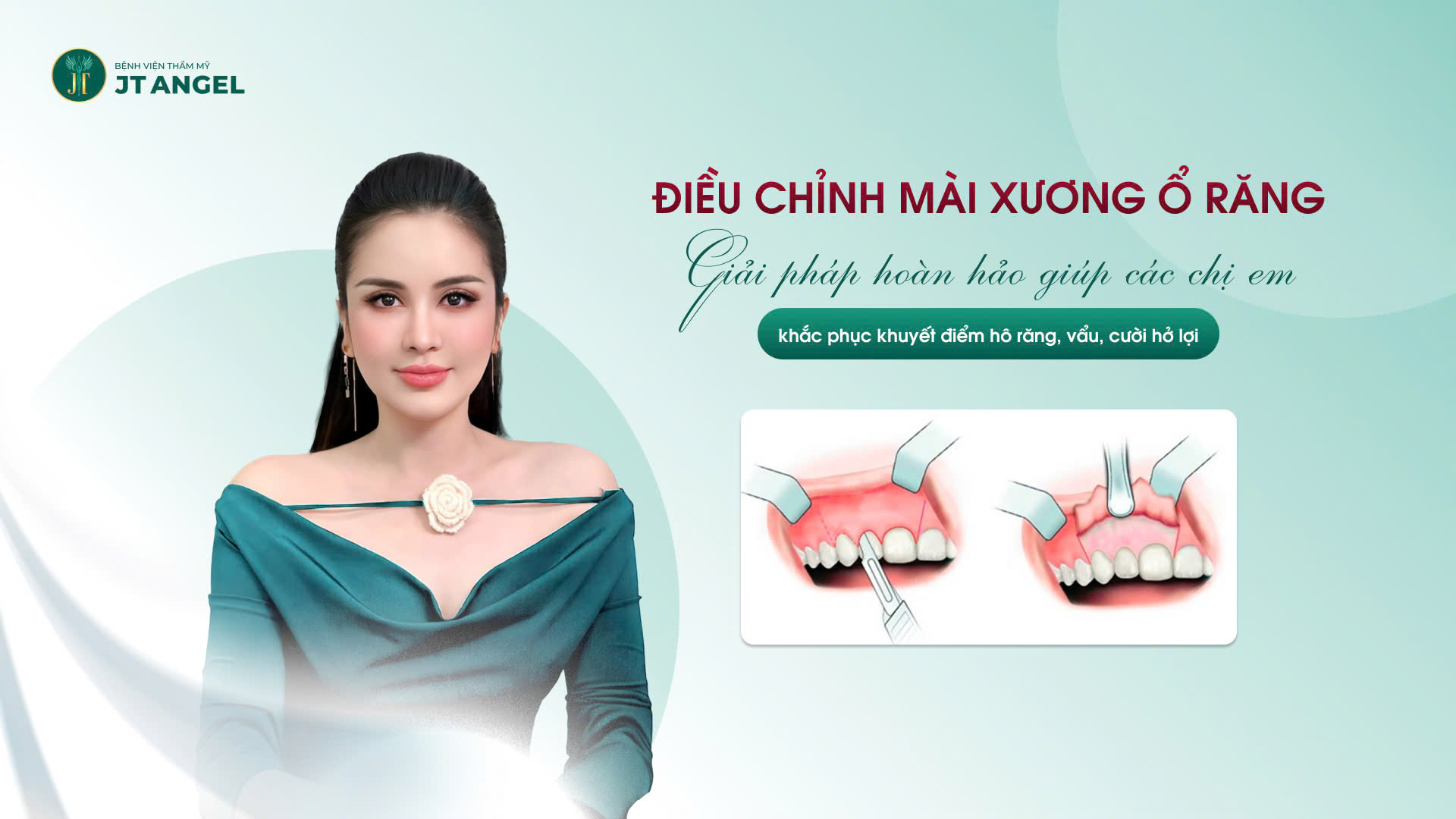 dieu-chinh-mai-xuong-o-rang-giai-phap-hoan-hao-giup-cac-chi-em-khac-phuc-khuyet-diem-ho-rang-vau-cuoi-ho-loi