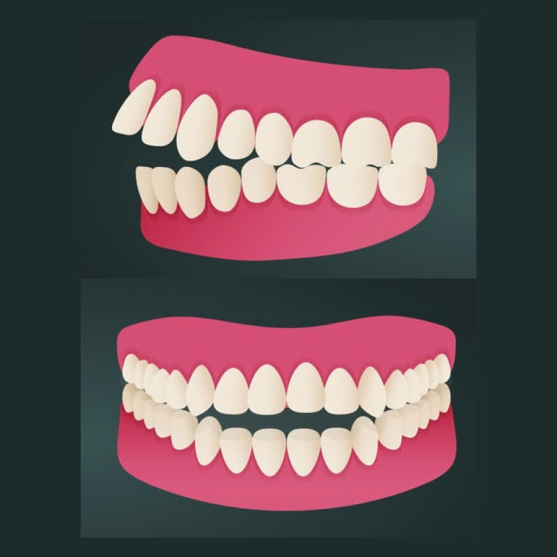 dieu-chinh-mai-xuong-o-rang-giai-phap-hoan-hao-giup-cac-chi-em-khac-phuc-khuyet-diem-ho-rang-vau-cuoi-ho-loi