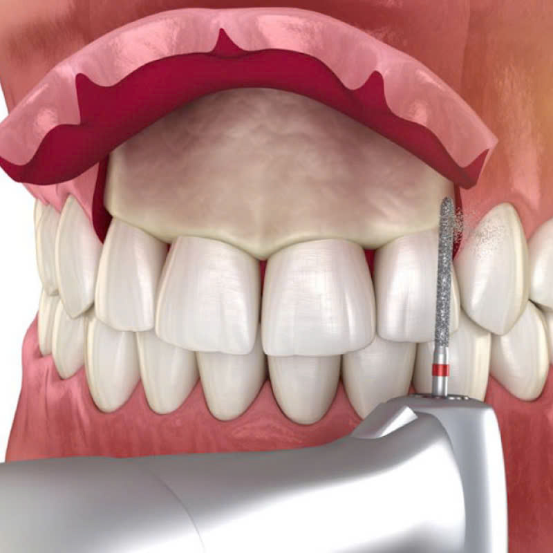 dieu-chinh-mai-xuong-o-rang-giai-phap-hoan-hao-giup-cac-chi-em-khac-phuc-khuyet-diem-ho-rang-vau-cuoi-ho-loi