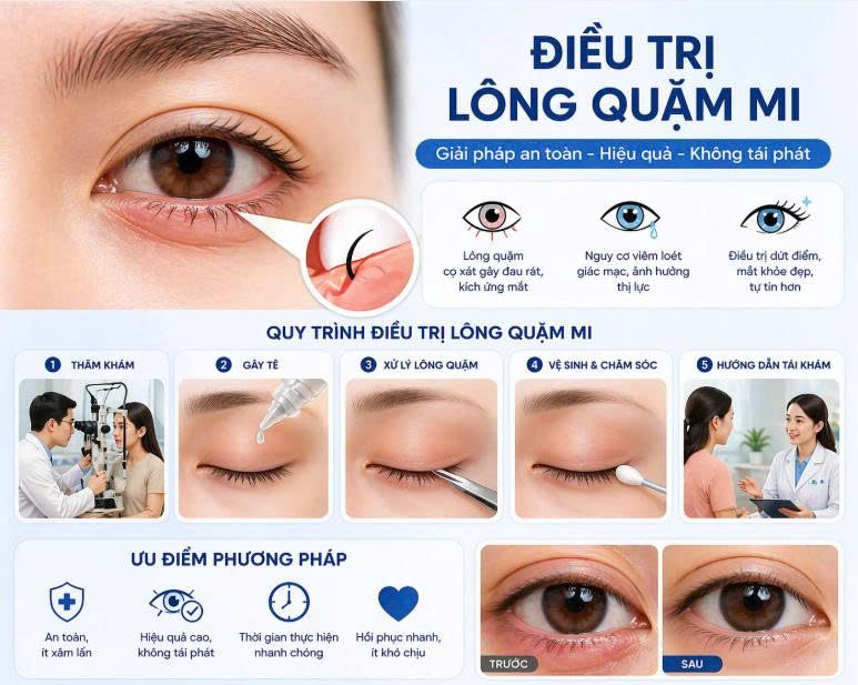 dieu-tri-long-quam-mi-bang-phau-thuat-cung-tim-hieu-phuong-phap-hieu-qua-va-an-toan-cho-doi-mat-khoe-dep