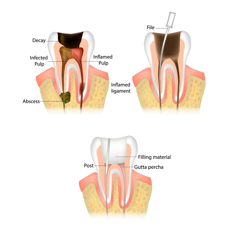 dieu-tri-tuy-rang-la-gi-nhung-doi-tuong-nao-can-phai-thuc-hien-dich-vu