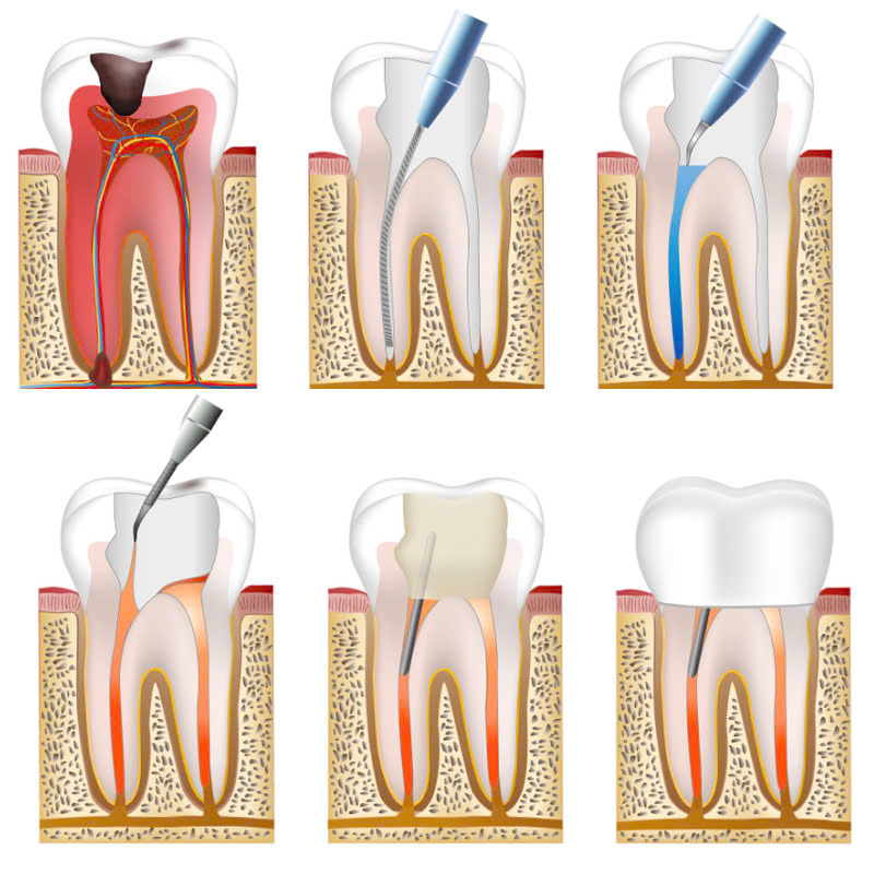 dieu-tri-tuy-rang-la-gi-nhung-doi-tuong-nao-can-phai-thuc-hien-dich-vu