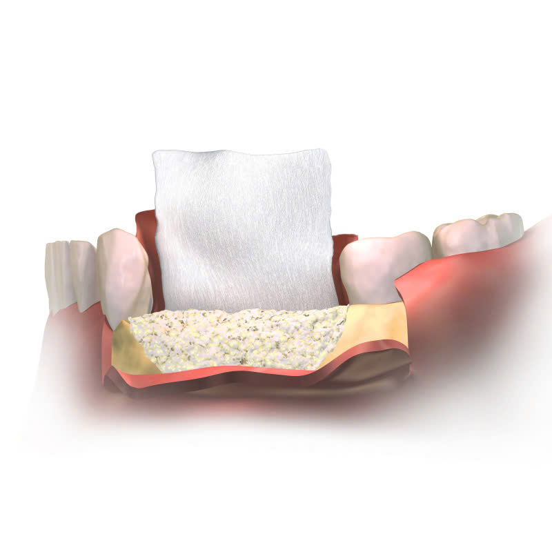 ghep-mang-xuong-la-gi-loi-ich-cua-ghep-mang-xuong-trong-phau-thuat-nha-khoa