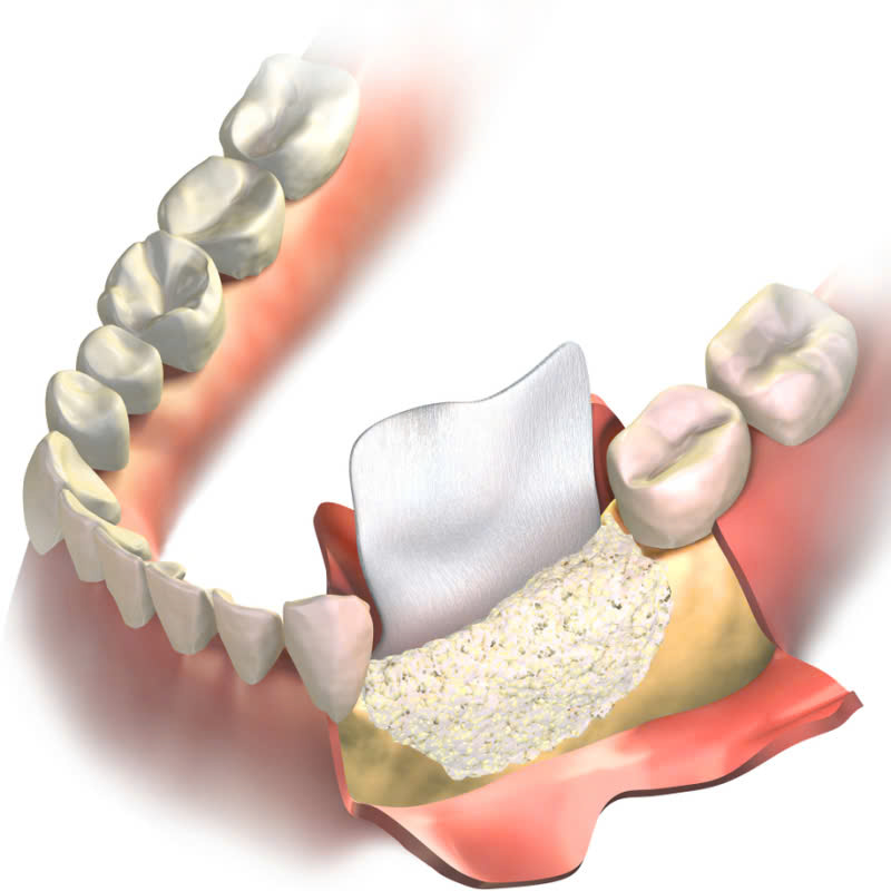 ghep-mang-xuong-la-gi-loi-ich-cua-ghep-mang-xuong-trong-phau-thuat-nha-khoa