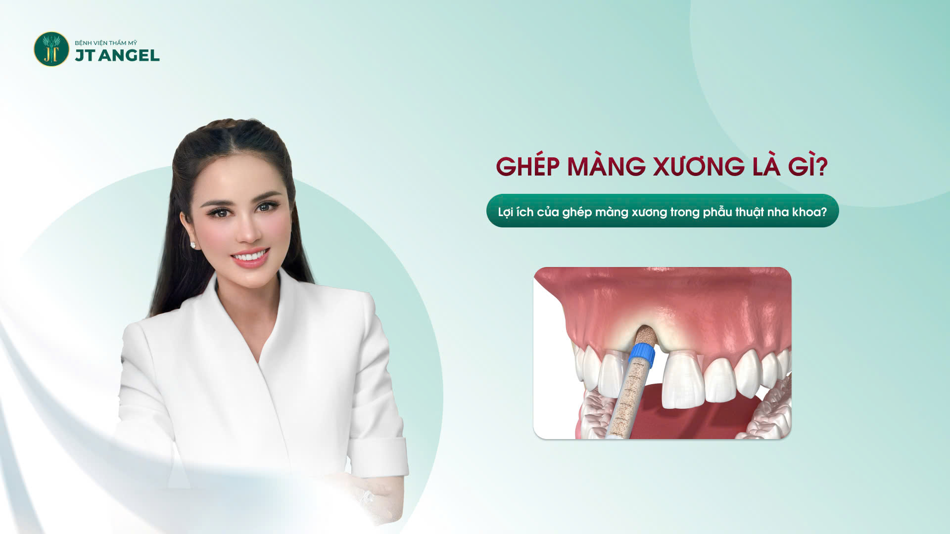 ghep-mang-xuong-la-gi-loi-ich-cua-ghep-mang-xuong-trong-phau-thuat-nha-khoa