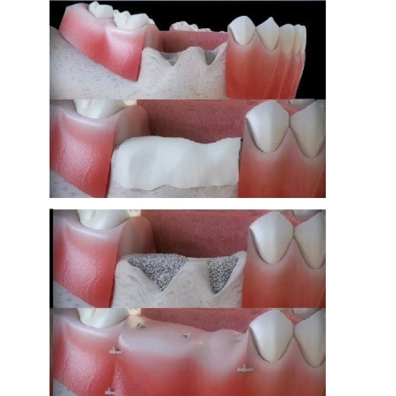 ghep-mang-xuong-la-gi-loi-ich-cua-ghep-mang-xuong-trong-phau-thuat-nha-khoa