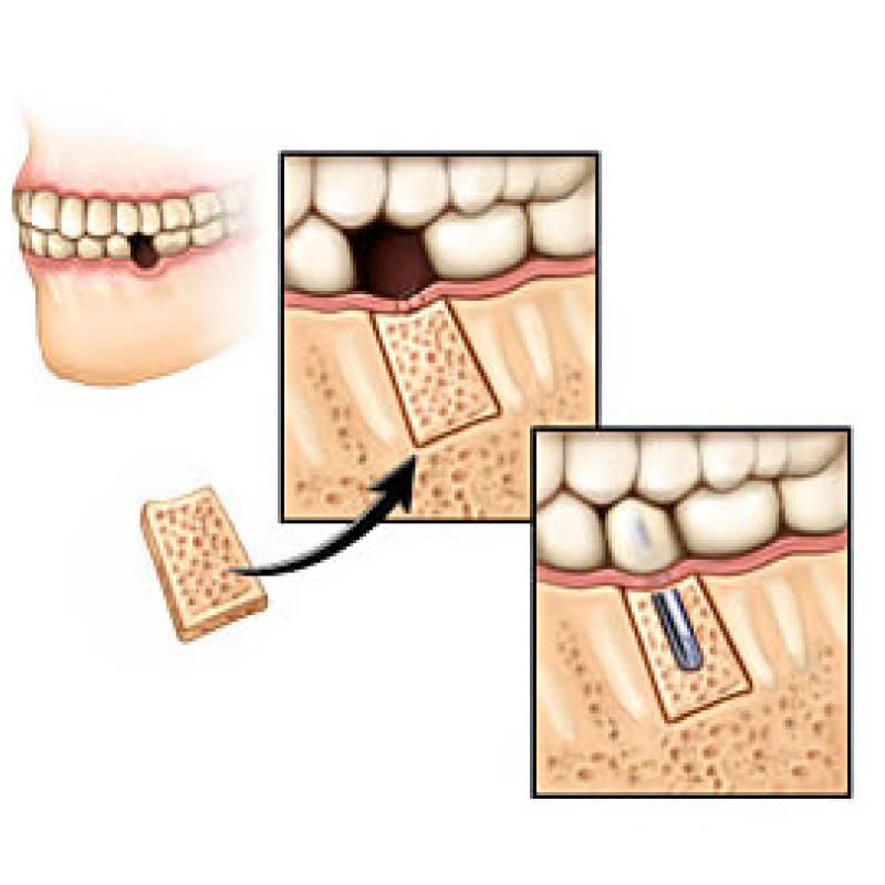 ghep-mang-xuong-la-gi-loi-ich-cua-ghep-mang-xuong-trong-phau-thuat-nha-khoa