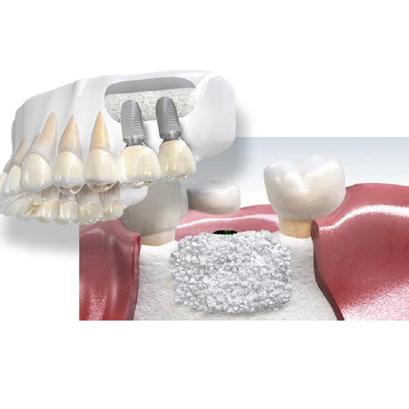 ghep-xuong-nhan-tao-la-gi-loi-ich-cua-ghep-xuong-nhan-tao-trong-phau-thuat-nha-khoa