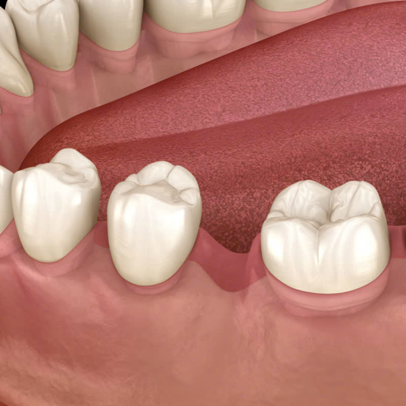 ghep-xuong-nhan-tao-la-gi-loi-ich-cua-ghep-xuong-nhan-tao-trong-phau-thuat-nha-khoa