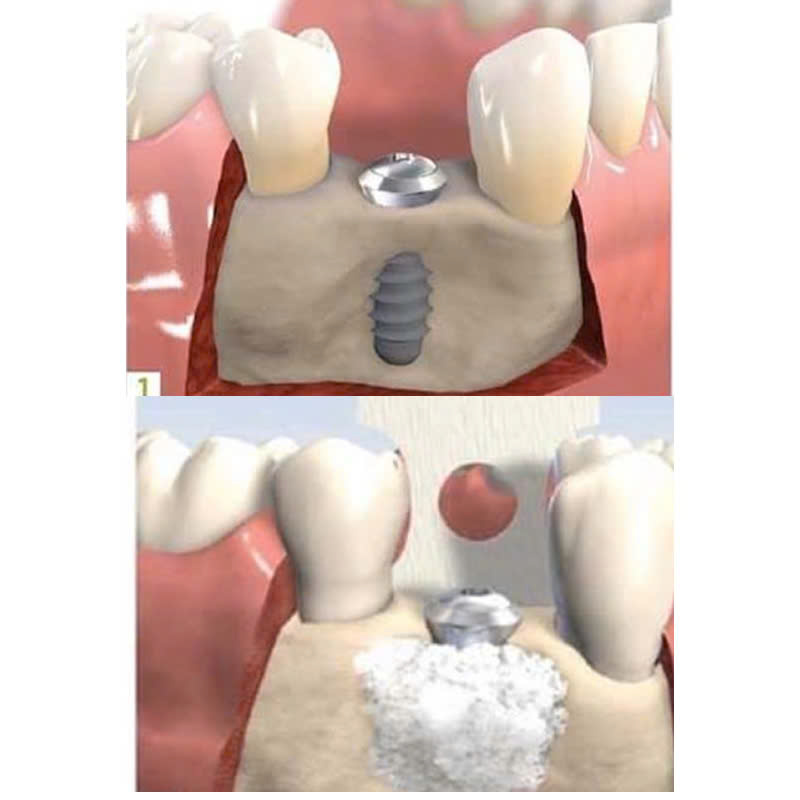 ghep-xuong-nhan-tao-la-gi-loi-ich-cua-ghep-xuong-nhan-tao-trong-phau-thuat-nha-khoa