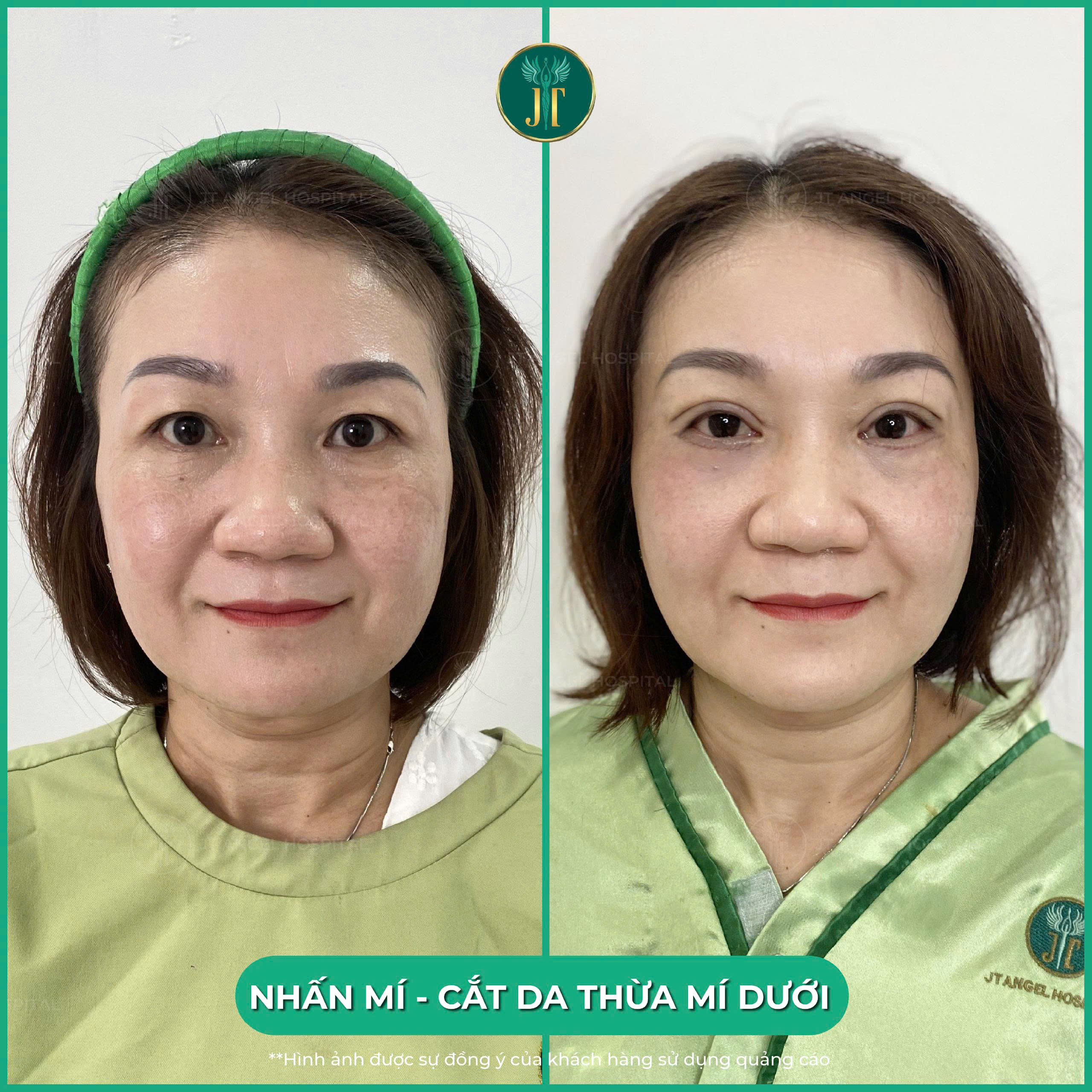 hinh-anh-truoc-sau-cat-mi-duoi-goc-nhin-chan-thuc-giup-ban-hieu-ro-hieu-qua-mang-lai