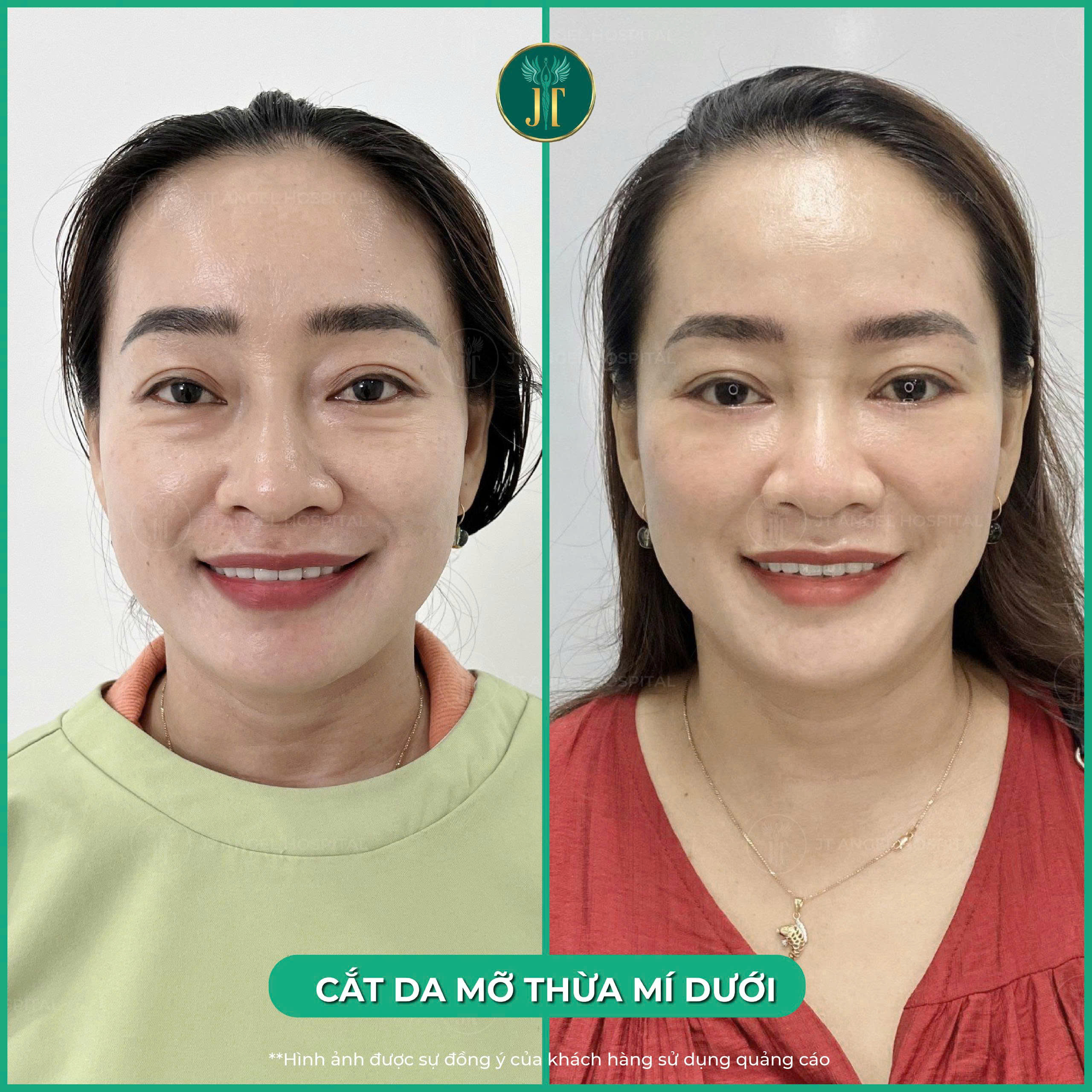 hinh-anh-truoc-sau-cat-mi-duoi-goc-nhin-chan-thuc-giup-ban-hieu-ro-hieu-qua-mang-lai