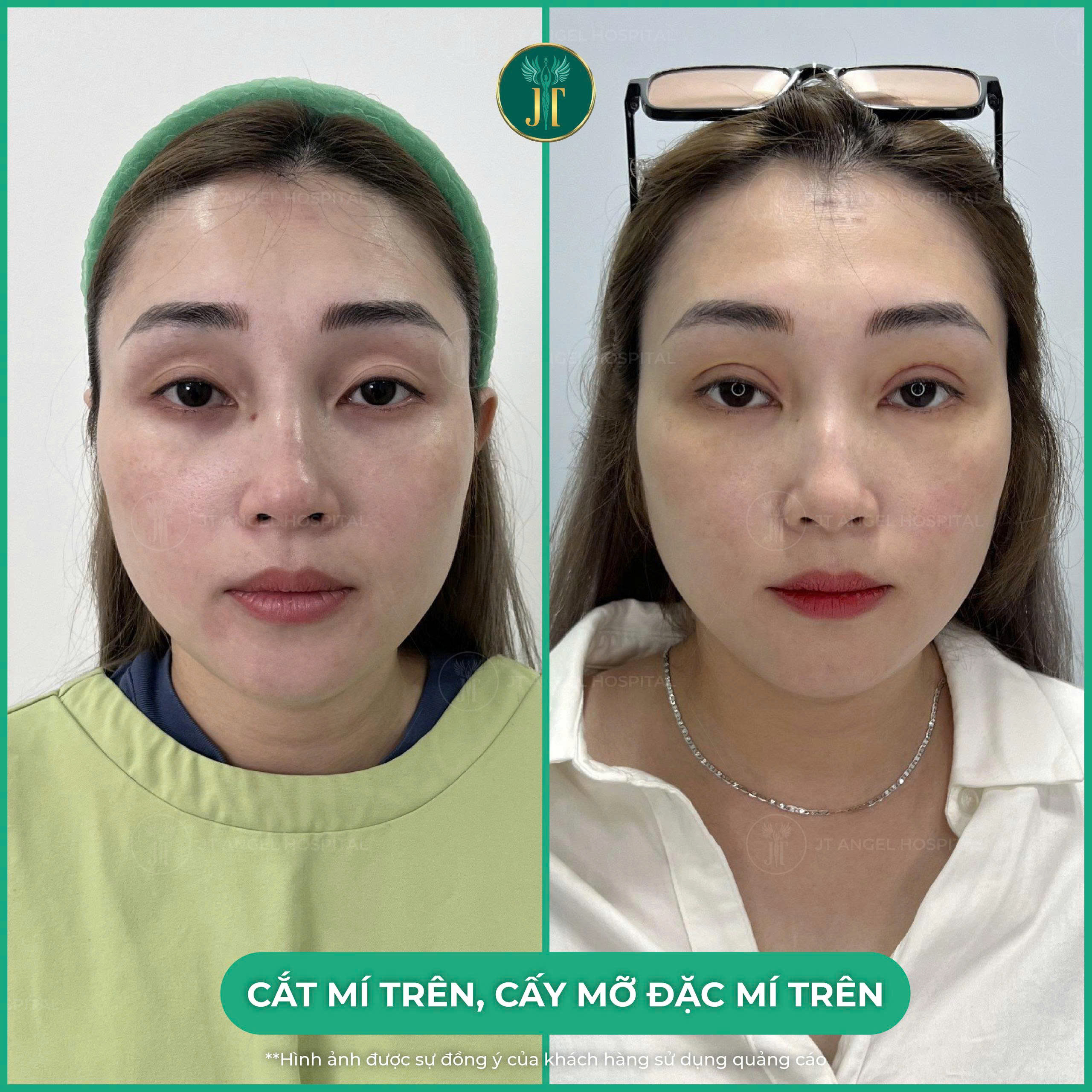 hinh-anh-truoc-sau-cat-mi-tren-tai-phan-bo-mo-goc-nhin-thuc-te-giup-ban-hieu-ro-hieu-qua
