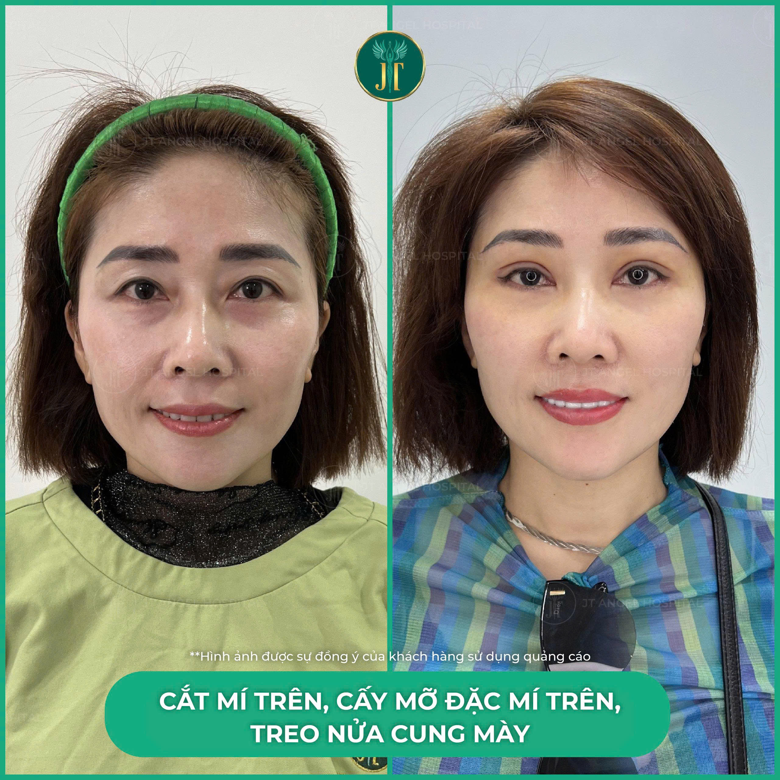 hinh-anh-truoc-sau-cay-mo-mat-minh-chung-ro-rang-cho-bi-quyet-giup-doi-mat-rang-ro-va-tran-day-suc-song