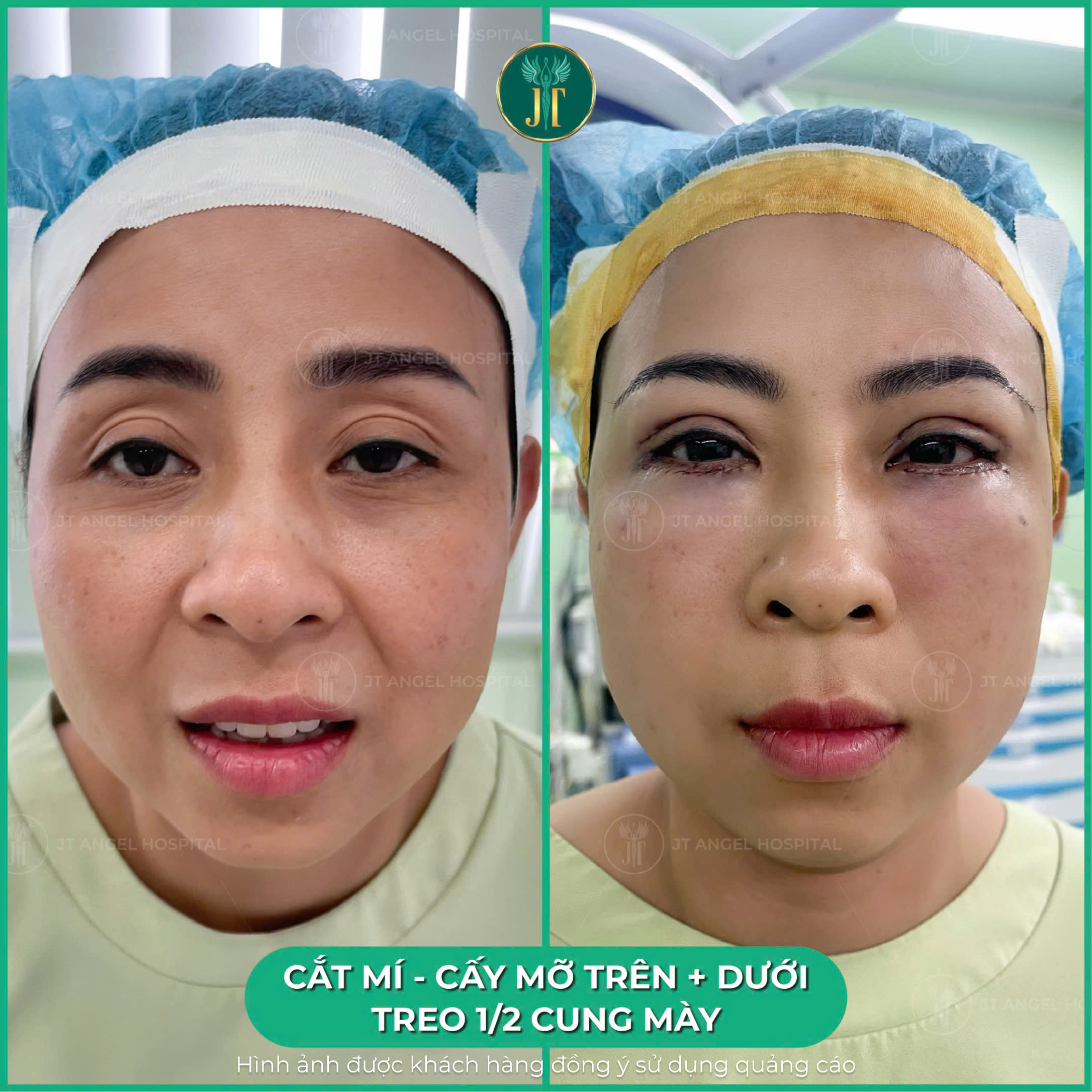 hinh-anh-truoc-sau-cay-mo-mat-minh-chung-ro-rang-cho-bi-quyet-giup-doi-mat-rang-ro-va-tran-day-suc-song